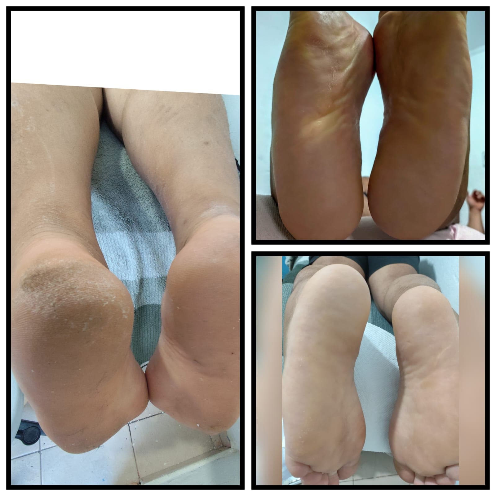 Podoprofilaxia Preventiva