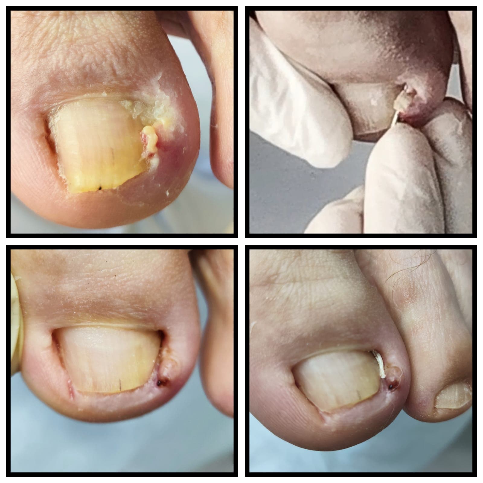 Correção de Unhas Encravadas Severas
